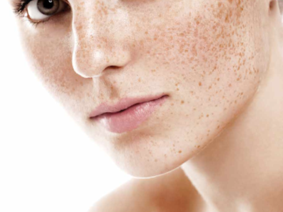 L'hyperpigmentation se manifeste lorsque la mélanine est produite en trop grande quantité sur certaines zones de la peau et elle peut être préoccupante.