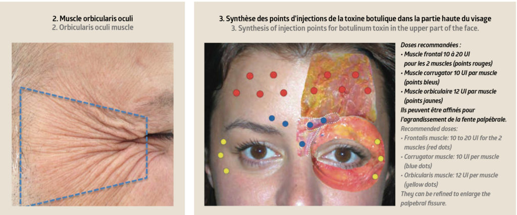 Toxine-botulique-schema-2-3 - Anti Age Magazine